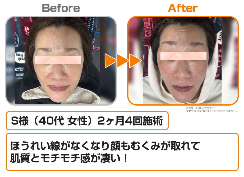 【美容鍼】S様（40代女性）