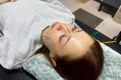 美容鍼（美顔鍼）